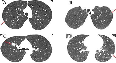 Clinical features and surgical outcomes of young patients with lung adenocarcinoma manifesting as ground glass opacity